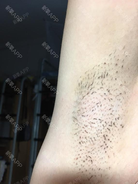 部分腋毛长出来了,但是数量比起没做脱毛之前明显减少_圈子-新氧美容