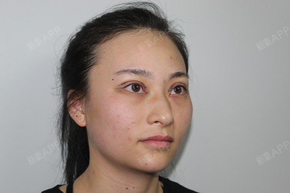 深圳上眼睑去脂好不好_效果图_氧气yba7b07上眼睑去脂术后第0天_新氧