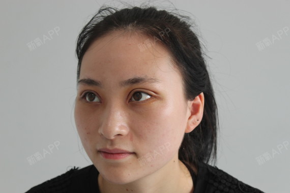 深圳上眼睑去脂好不好_效果图_氧气yba7b07上眼睑去脂术后第7天_新氧