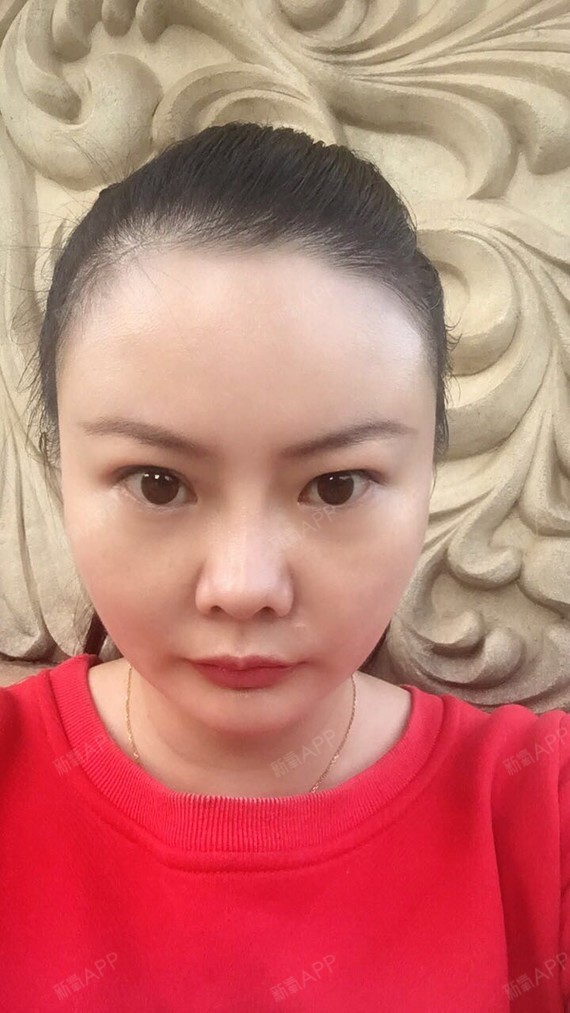 好不好_效果图_梨涡浅笑a自体脂肪全脸填充术后第146天_新氧美容整形