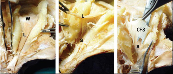 结膜上穹窿联合筋膜鞘悬吊