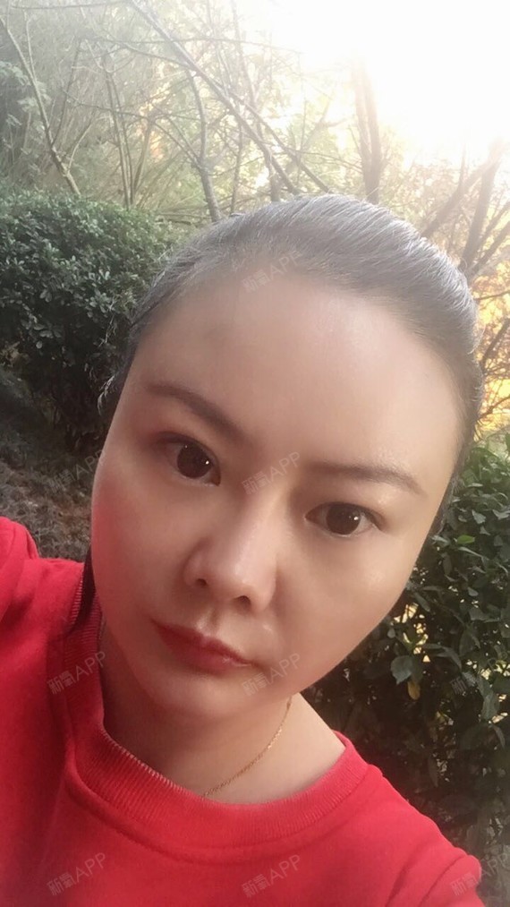 好不好_效果图_梨涡浅笑a自体脂肪全脸填充术后第146天_新氧美容整形