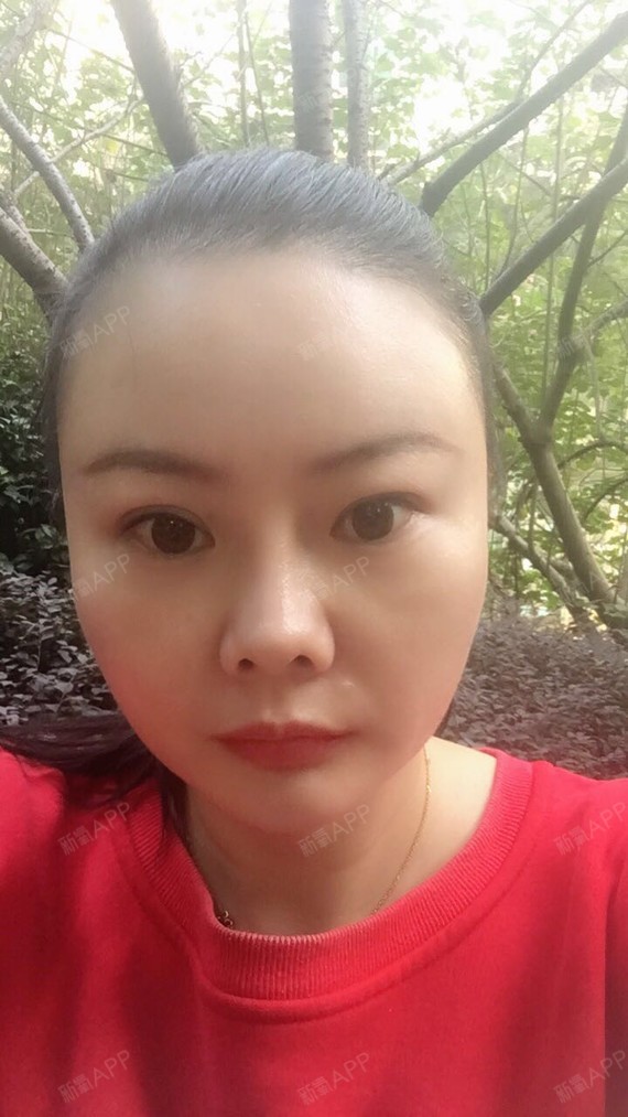 好不好_效果图_梨涡浅笑a自体脂肪全脸填充术后第146天_新氧美容整形