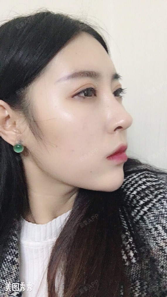 我还是比较喜欢侧脸,弧度很好看,很适合我,现在也可以正常摸鼻子了,一
