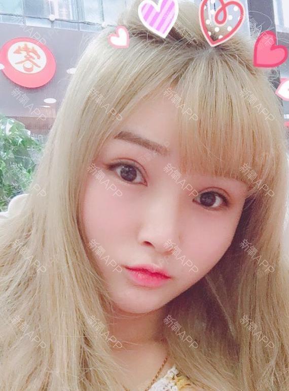 穿草裙的少女切开双眼皮第21天美丽日记-新氧美容整形