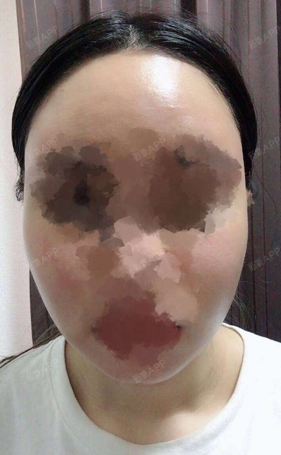 首尔特别v-line瓜子脸手术好不好_效果图_sjjelqv-line瓜子脸手术术后