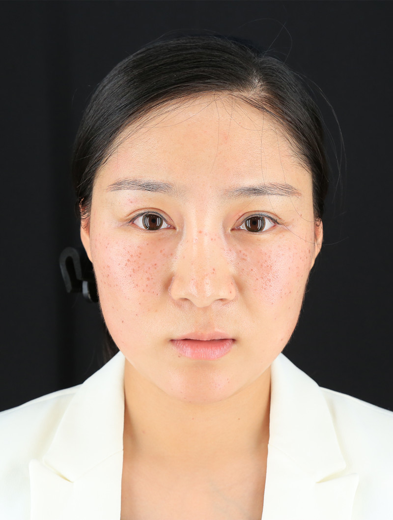 来自合集·皮秒激光共3篇编辑于2017年11月下面这张照片是第六天的