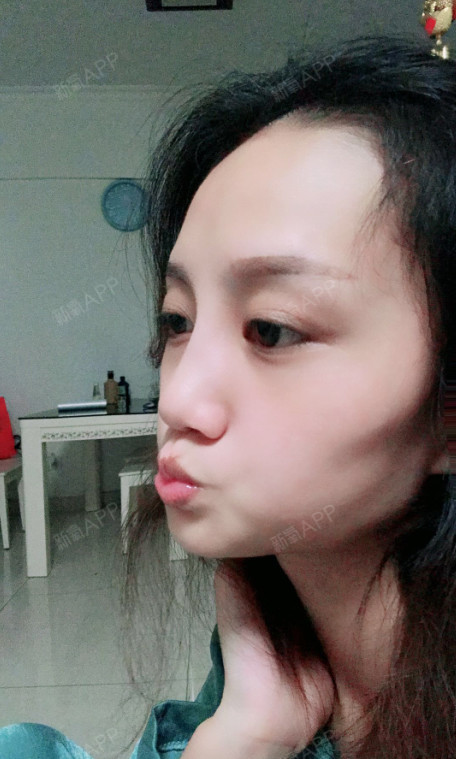 【线雕隆鼻第9天】时间过的好快啊,做完线雕隆鼻将近_圈子-新氧美容