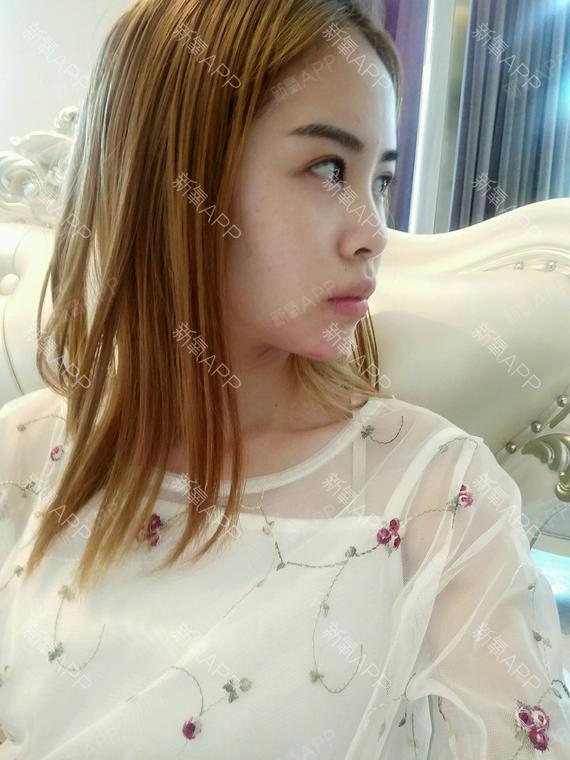 郑州玻尿酸垫下巴好不好_效果图_嘉懿1992玻尿酸垫下巴术后第54天