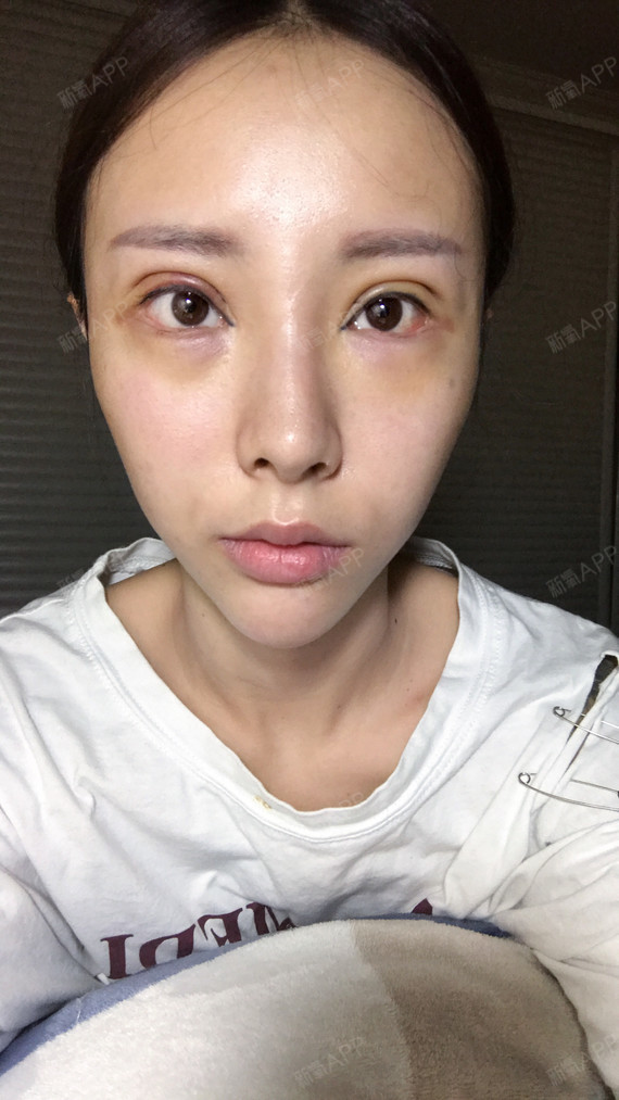 下眼下至术