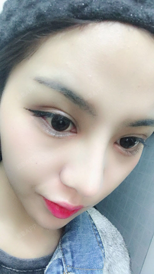 新氧- adila919 | 开内眼角 | 术后当自强