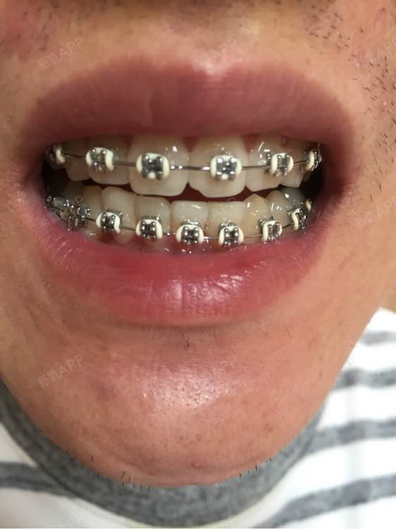 我已经变身钢牙7个多月了!抱歉抱_圈子-新氧美容整形
