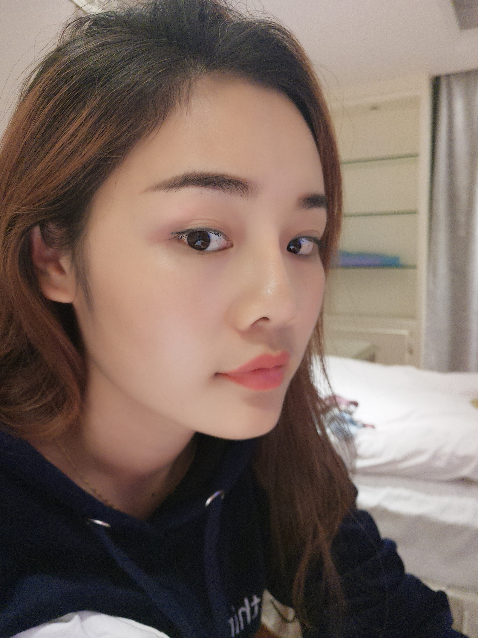 硅胶隆鼻第80天