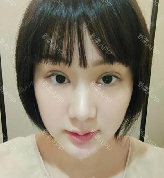 布丁熊嘟嘟嘟切开双眼皮第10天美丽日记