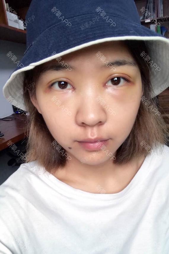 做完手术第一天,眼睛再也不是一条缝了,大大的眼睛,_圈子-新氧美容