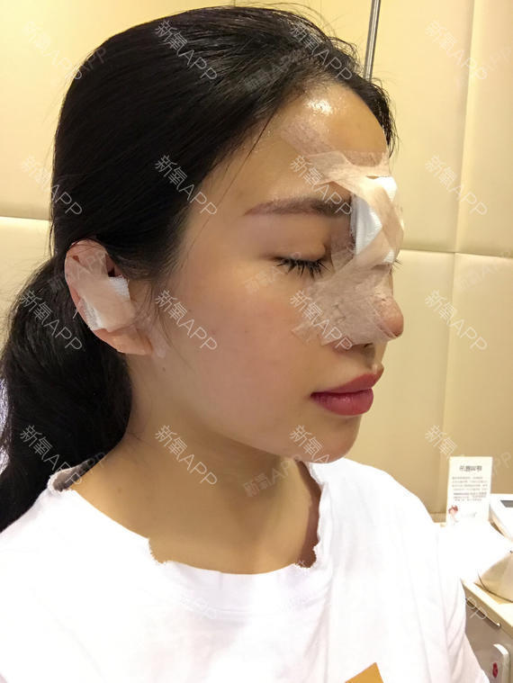 硅胶隆鼻好不好_效果图_林沐慕硅胶隆鼻术后第3天_新氧美容整形