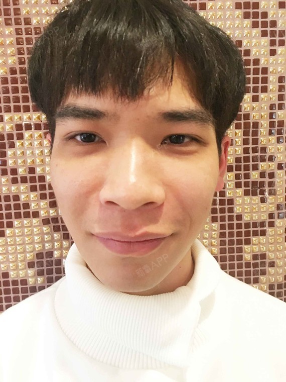 新氧- 王春桃 | 玻尿酸 | 术后当自强 | 武汉同城 | 玻尿酸填充苹果肌