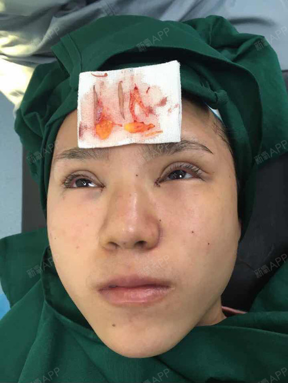 终于有勇气做双眼皮啦!