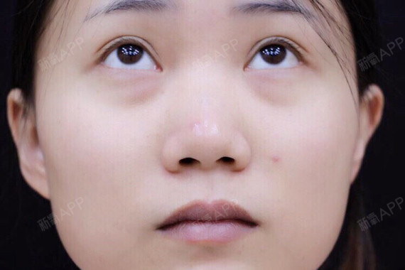 我是个天生的塌鼻子,偏偏又有张圆圆的大脸,看着五官_圈子-新氧美容