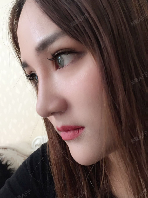 星星兴兴耳软骨复合隆鼻第88天美丽日记