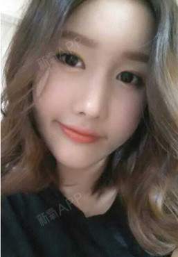 义乌耳软骨复合隆鼻好不好_效果图_张瑾瑶耳软骨复合隆鼻术后第30天_