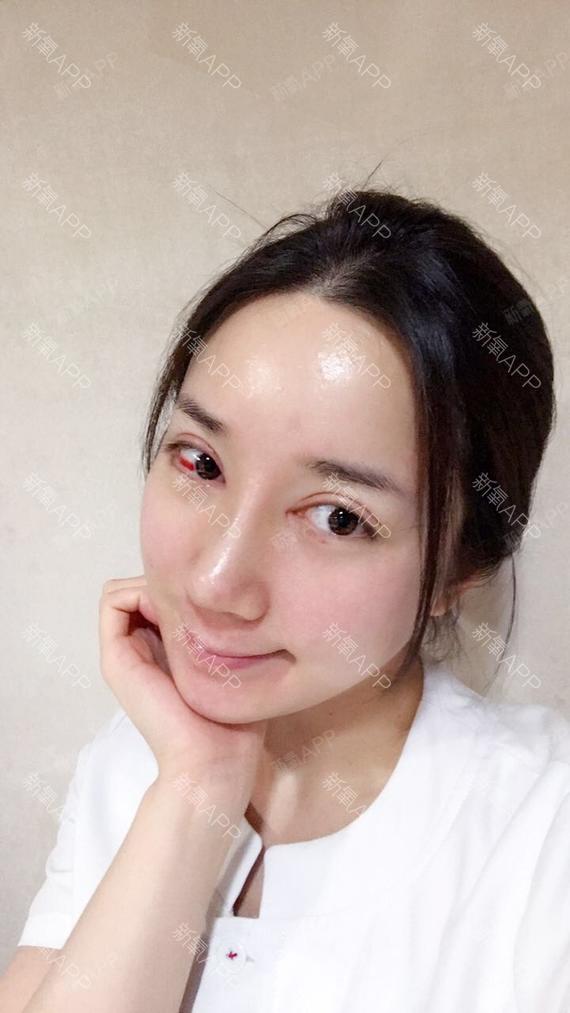 开内眼角好不好_效果图_前方高能来袭开内眼角术后第7天_新氧美容整形