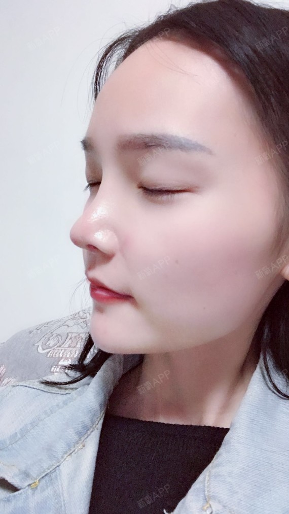 【长沙希美鼻综合术后35天】