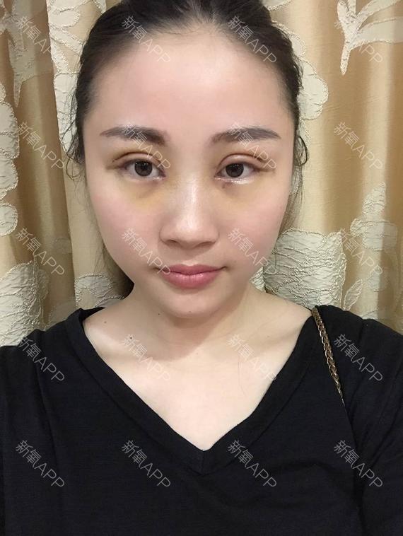 开内眼角怎么样_恢复过程_效果如何_光阴不负容颜整形日记8.