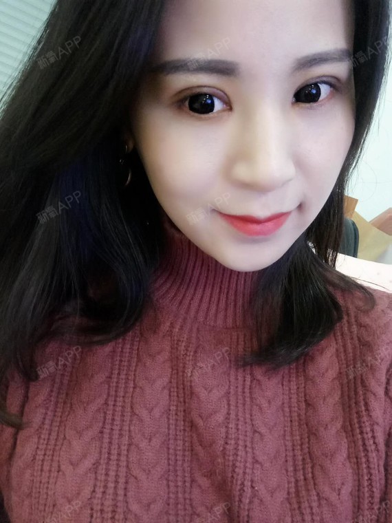 咳咳咳今天是我双眼皮手术第十四天啦哈哈哈现在的眼睛_圈子-新氧美容