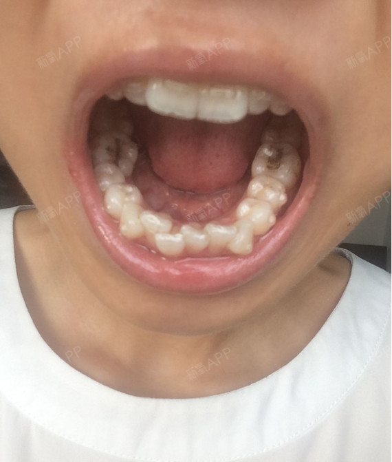 以前的牙齿参差不齐