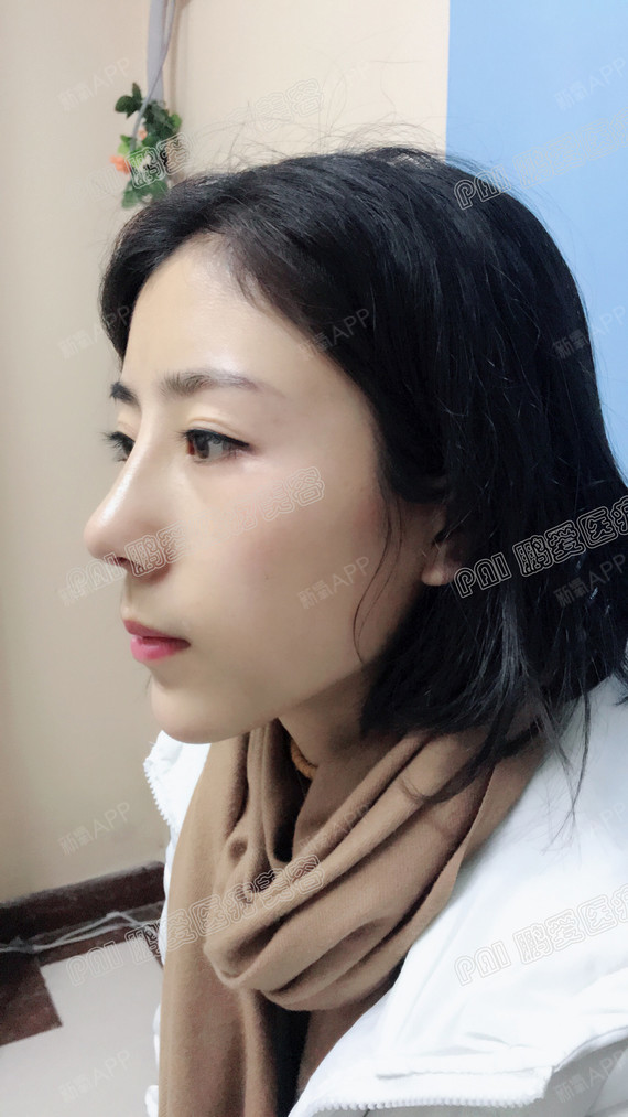 今天是综合鼻的第七天,去医院复诊拆线了