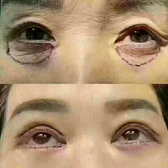 眼袋的形成与眼部脂肪堆积有很大关系,因此,想要有效_圈子-新氧美容