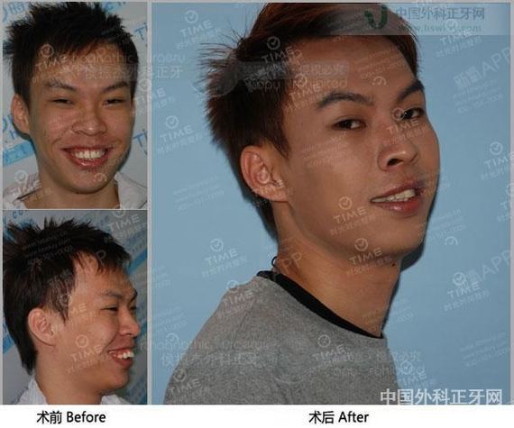 正畸不用去韩国,时光一步到位!