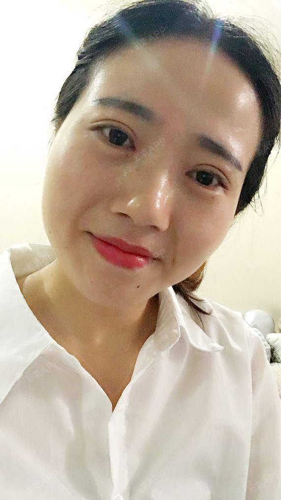 双眼皮做了一周了,现在感觉恢复的挺好的,给大家分享_圈子-新氧美容