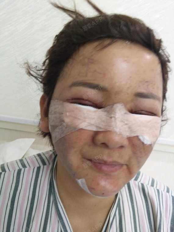 深圳外切去眼袋好不好_效果图_大枝姐外切去眼袋术后第1天_新氧美容