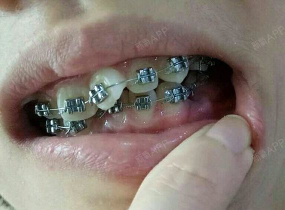 这是三个月了,上牙看着已经比刚开始好多了,那个傲娇的小