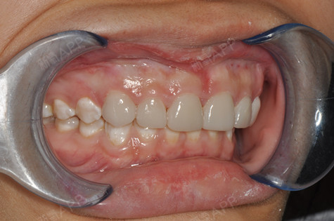 瓷贴面好不好_效果图_mp136901瓷贴面术后第2天_新氧美容整形