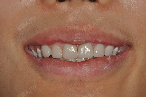 瓷贴面好不好_效果图_mp136901瓷贴面术后第2天_新氧美容整形