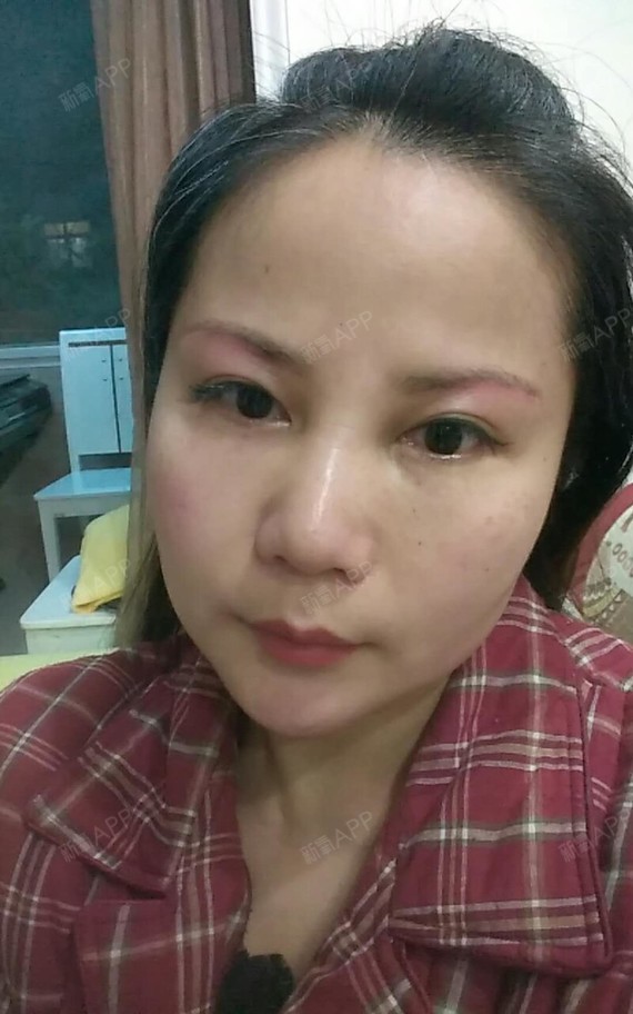 氧气udt8c73切眉术术后第26天美丽日记_新氧整形