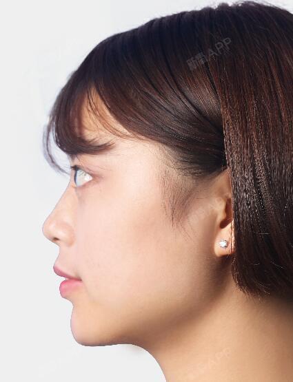 【济南艺星玻尿酸垫下巴术后第2天】超级自然,我妈都_圈子-新氧美容