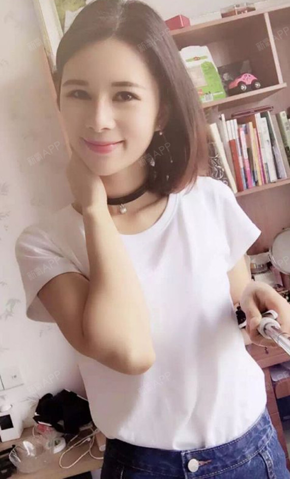 好不好_效果图_梨涡dimpl自体脂肪全脸填充术后第98天_新氧美容整形