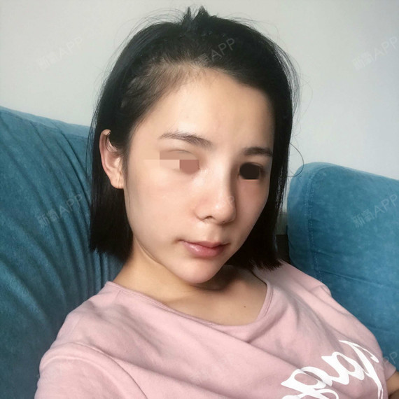线雕隆鼻2天啦,和所有的宝宝一样做完治疗后,每天起_圈子-新氧美容
