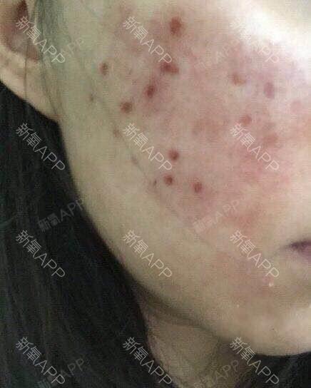 术后第4天,看脸上开始结痂了.祛痘用点阵激光确实有效果.