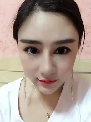 开内眼角怎么样_恢复过程_效果如何_软妹属性ciw整形日记11.