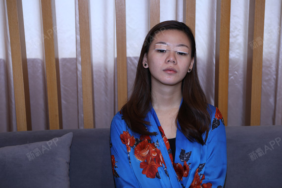 重庆切开双眼皮好不好_效果图_午夜飞蝶切开双眼皮术后第0天_新氧美容