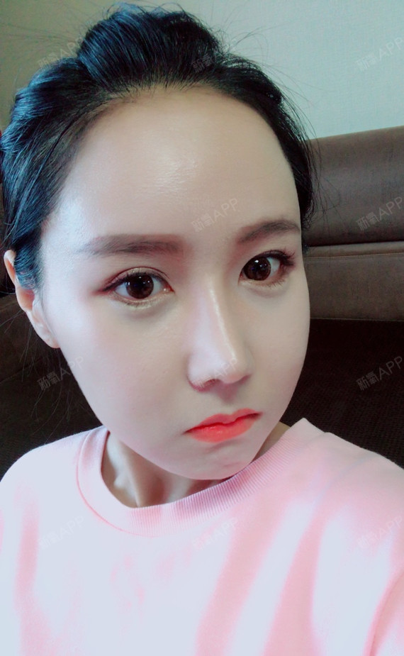 鼻部多项好不好_效果图_小仙女5555鼻部多项术后第14天_新氧美容整形