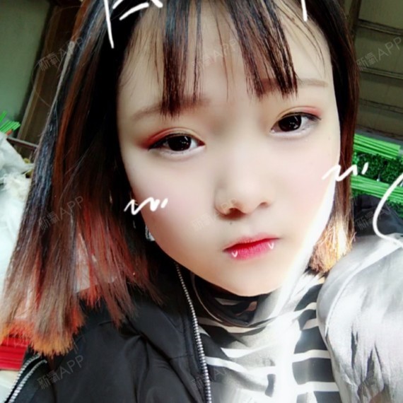 贵阳注射瘦脸好不好_效果图_ㄟ不苟言笑rht注射瘦脸术后第32天_新氧