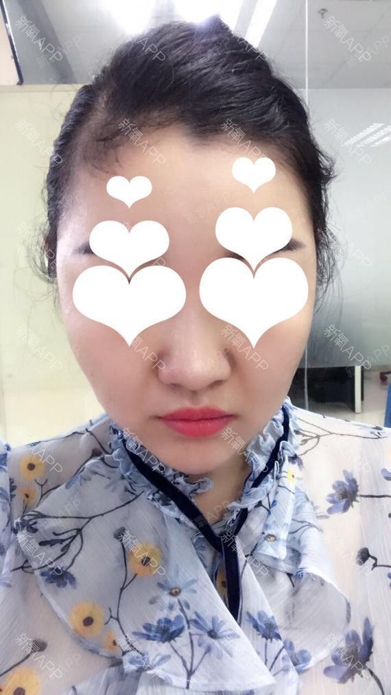 【谢景良医疗美容】2016年面部吸脂顾客术后回访对_圈子-新氧美容整形