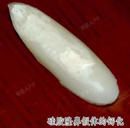 之所以有人会说硅胶假体最好定期更换,是因为硅胶有可能出现老化