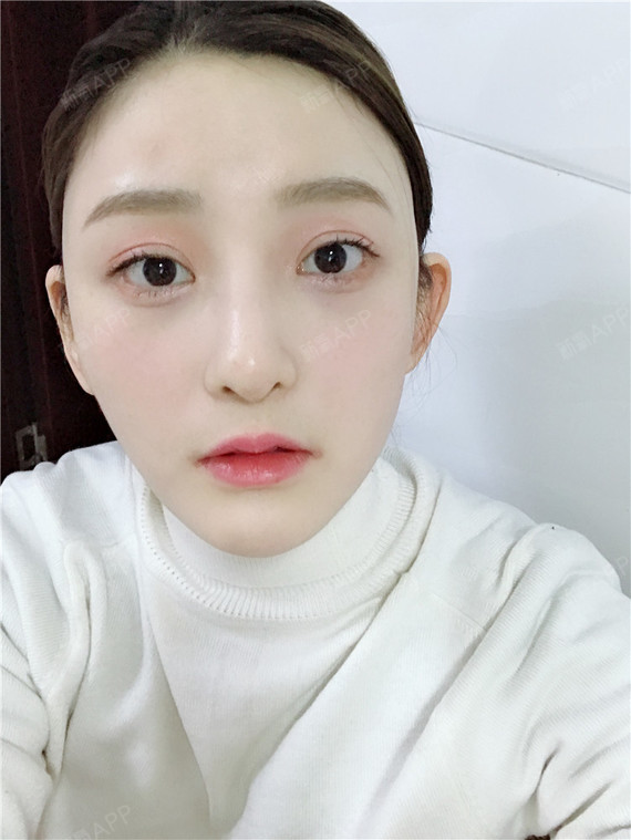 武汉下眼下至术好不好_效果图_花海海海下眼下至术术后第144天_新氧